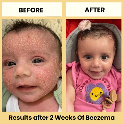 babee eczema cream