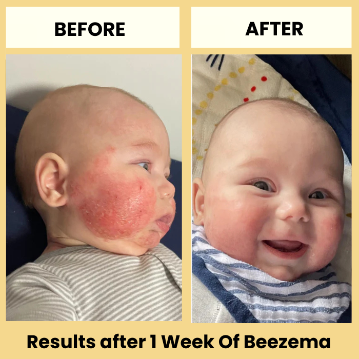 babee eczema cream