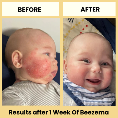 babee eczema cream