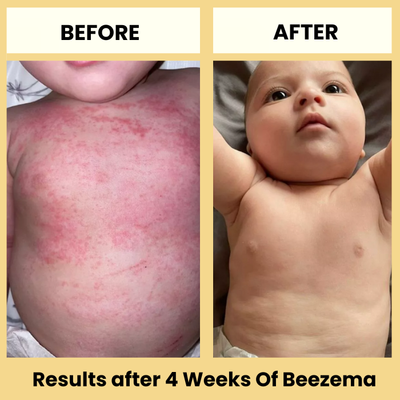 babee eczema cream